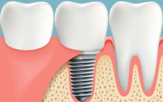 Implantaten